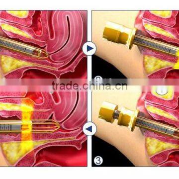 Non-invasive Vagin Tightening Equipment photo-6
