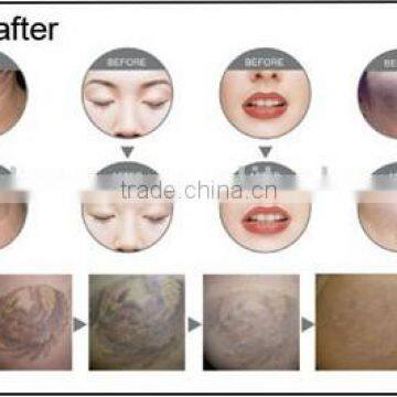 Laser Tattoo Machine photo-6