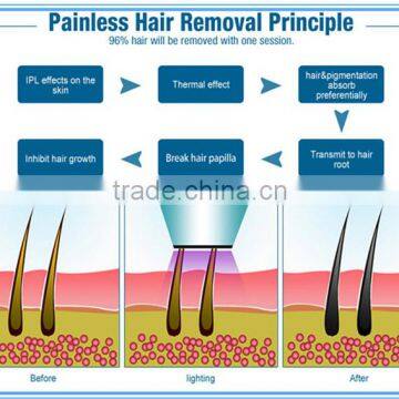 Pain-Free Hot Selling 808 Diode Chin & Lip Hair Removal Laser For Hair Removal photo-4