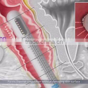 High Frequency  2017 Trending HIFU Vaginal Tightening Machine For Sale Back Tightening photo-5