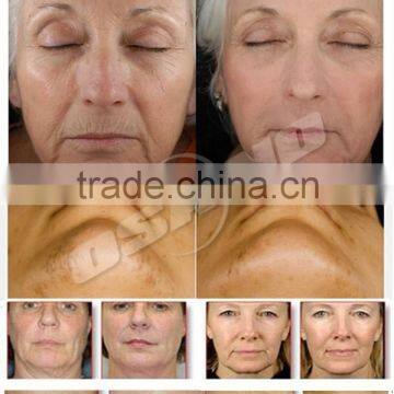 Fast Result Yag Laser Machine Acne Facial Treatment photo-6