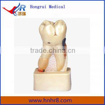 High Quality Dissected Model of Dental Teeth Disease