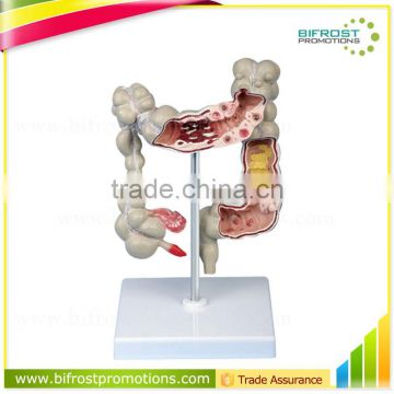 Pathology Colon Model Organs Human Body Anatomy