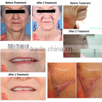 2015 Hottest Derma Pen/electric Microneedle Derma Pen Needle Cartridge photo-5