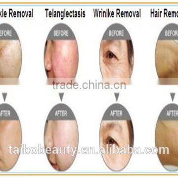 Agent Wanted Professional Mini Home Use Shr Elight nd Yag Laser 3 in 1 Beauty Machine From China Factory photo-6