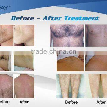 Advanced 808nm Diode Laser Permanent Hair Removal Beauty Equipment&machine