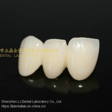 Dental Crown Zirconia PFZ, Dental Teeth, Dental Prosthesis, Laboratoire Dentaire, Dentallabor, Laboratorio Dental, Dental Laboratory, Shenzhen LJ Dental Lab China photo-3