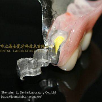 Dental precision attachment, dental attachment, dental denture, laboratoire dentaire, Dentallabor, laboratorio dental, dental laboratory, Shenzhen LJ dental lab China