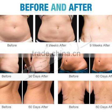 Portable 3 in 1 Cryotherapy Fat Freezing Machine Vacuum, Fat Freeze Cryotherapy Cooling Vacuum photo-6