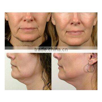 Portable Fractional rf Microneedle Wrinkle Removal Machine/skin Lifting Micro Needle rf Machine