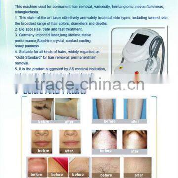 50-60HZ 808nm Diode Laser Unwanted Hair Permanent Hair Removal Machine 3000W photo-4