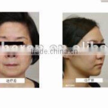 High Frequency Machine For Acne HIFU High Intensity Focused Ultrasound Face Lift 4MHZ And Skin Tighten Machine With Large Discount 0.2-3.0J