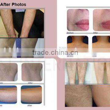 Only for Overseas Distributors 2016 New Diode Laser Depilation 808nm Equipment With 20 Million Shots photo-6