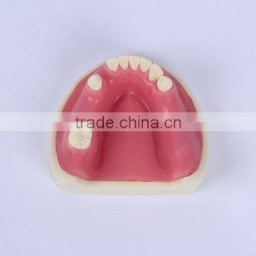New Type Good Quality Dental Implant Model With Teeth