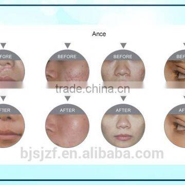 Carboxytherapy F5 Co2 RF/Glass Pipe Fractional Vagina Vascular Treatment Tightening Co2 Laser Equipment Anybeauty Original Manufacturer 10MHz photo-6