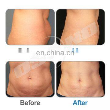 Freeze Contour 4 Handles Fat Freezing Device Cryo Sculpting Kryolipolyse Machine photo-6