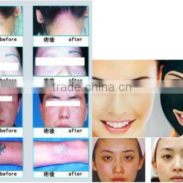 Laser Tattoo Removal Equipment 800mj Remove Pigment And Tattoo Machine 532nm / Q-switch Laser Tattoo Removal Machine Naevus Of Ota Removal Naevus Of Ito Removal photo-5