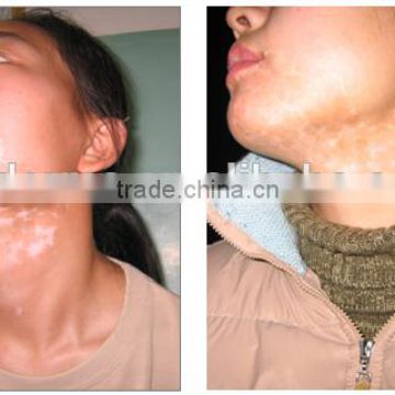 311NM NB UVB lamp for Vitiligo/Vitiligo/Psoriasis---311nm