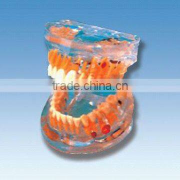 pathology Transparent teeth model