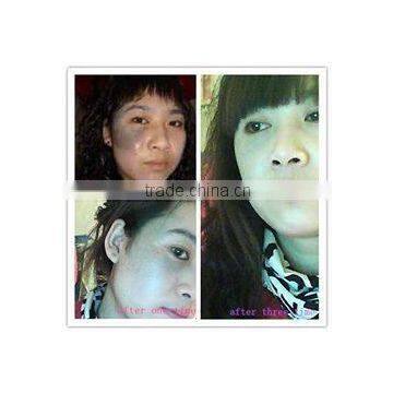 Spot Scar Pigment Removal Fractional Co2 Laser Sanhe Products Fractional 100um-2000um Face Lifting Co2 Laser /co2 Laser Surgery Machine Mole Removal photo-2