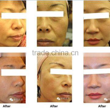 Deep Wrinkle Removal Hifu High Intensity Focus Ultrasound Hifu Wrinkle Removal Machine Pigment Removal