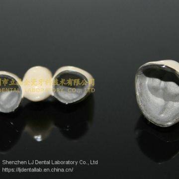Dental Crown Porcelain Fused Metal, PFM, VMK, Dental Prostheses, Laboratoire Dentaire, Dentallabor, Laboratorio Dental, Dental Laboratory, Shenzhen LJ Dental Lab China photo-4