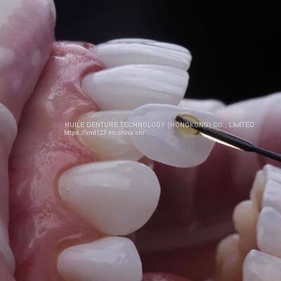 E.max Crowns Lab from China E.max All-Ceramic Dental