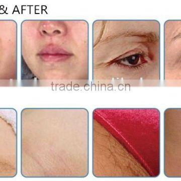 3 Different Radio Frequency Adjustable RF Aesthetic Equipment Skin Tightening Face Shaping photo-5