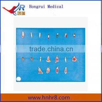 Hot Sale Dental Teeth Diseases Model