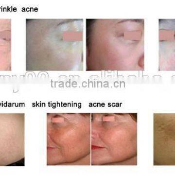 Upgrades Gold Multifunctional Co2 Fractional Laser(aesthetic Laser)