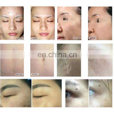 Glass Rf Tube Engraving Fractional Co2 Fractional Laser Stretch Marks Acne Scar Removal Cutting Machine photo-5