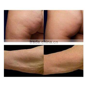 rf Frequency Combine With Cooling System/fractional rf Wrinkle Removal/face Lifting