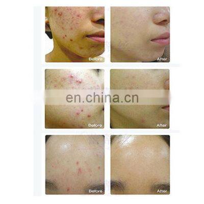 Vertical Hot Sale Skin Rejuvenation 7 Colorful Pdt Led Light Therapy Machine photo-5