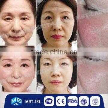 CE/ISO Approve Skin Care Beauty Machine for Wrinkle Removal and Face Lift Radio Frequency Machine photo-4