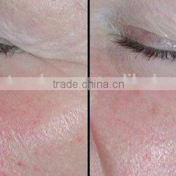 Laser Non Surgical Red Blood Removal, Laser Vein Removal photo-5