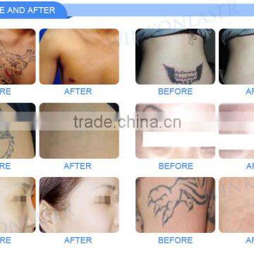 China Supplier OEM ODM Approved 2 Years Warranty Laser Rejuvi Tattoo Removal Machine