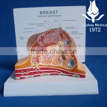 Pathological breast model
