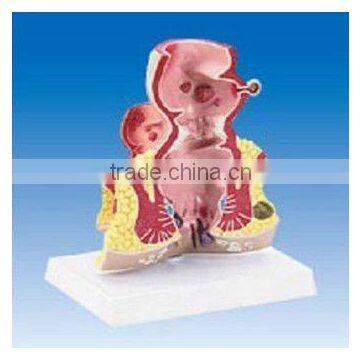 Rectum common disease model