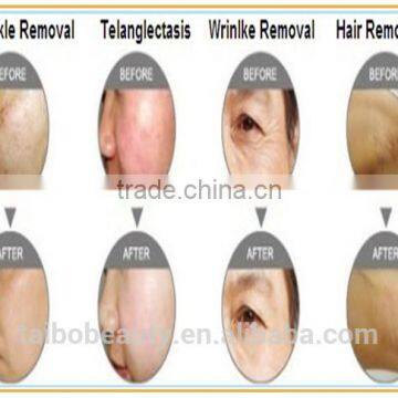 30 Million Shots!!!! Best Sell SHR Hair Removal Equipment, With CE Certification Laser Machine