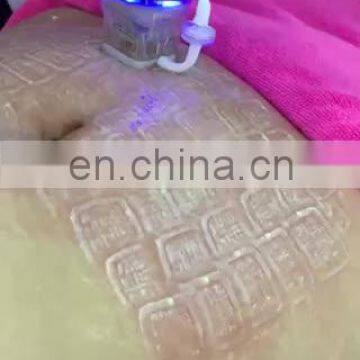 Portable fractional rf machine/ microneedle rf fractional/ stretch marks removal fractional rf beauty machine