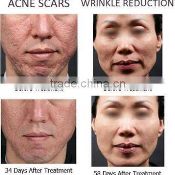 Hot Sale Radiofrequency Fractional RF Microneedle Laser Facial Rejuvenation Machine photo-2