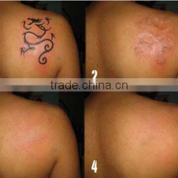 CE Certification Q Switch ND YAG Laser Naevus Of Ito Removal Machine For Tattoo Pigmentation Removal Freckles Removal