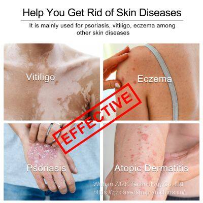 High Effective Solution 308nm Excimer Uvb Laser Vitiligo Treatment Device for Psoriasis and Vitiligo photo-4
