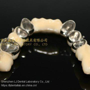 Telesope crown, Dental telescope denture, dental prosthesis, laboratoire dentaire, Dentallabor, laboratorio dental, dental laboratory, Shenzhen LJ dental lab China
