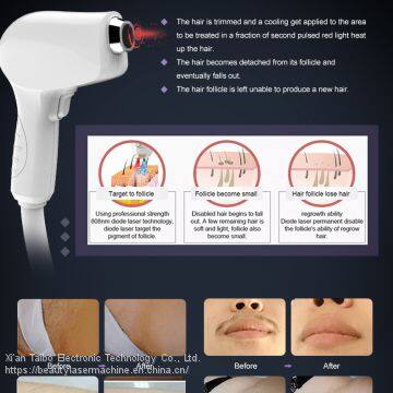 Diode Laser 808 nm Hair Removal Machine Portable 808 nm Diode Laser Epilator Clinic Use Permanent Laser Hair Removal Machine photo-5