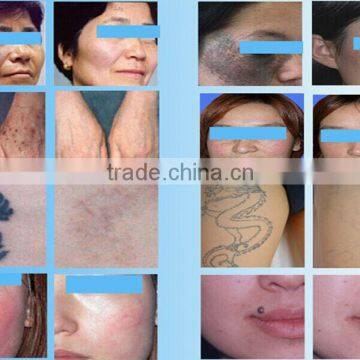 Freckles Removal Sanhe SQ-2 Nd: Yag Laser Skin Tattoo Removal Laser Machine Care System/ 2016 Popular Q-switch Nd-yag Laser Tattoo Removal photo-5