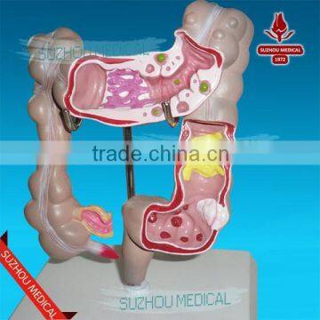 Colon rectum common disease model