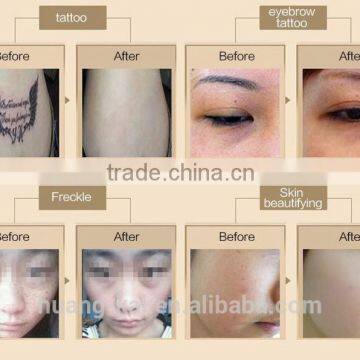 nd Yag Laser for Tatoo Removal Machine Q-switch Ng Yag Laser With Factory Price photo-6