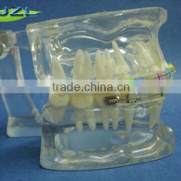 transparent orthodontic tooth model