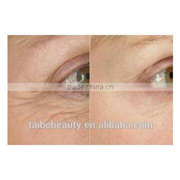 Fractional rf Micro Needling Dark Spot Removal Machine From Beauty Salon Equipment Supplier